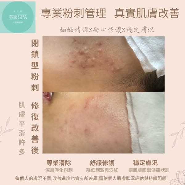 痘痘、粉刺怎麼處理才對？5 種痘痘類型與正確清粉刺觀念
